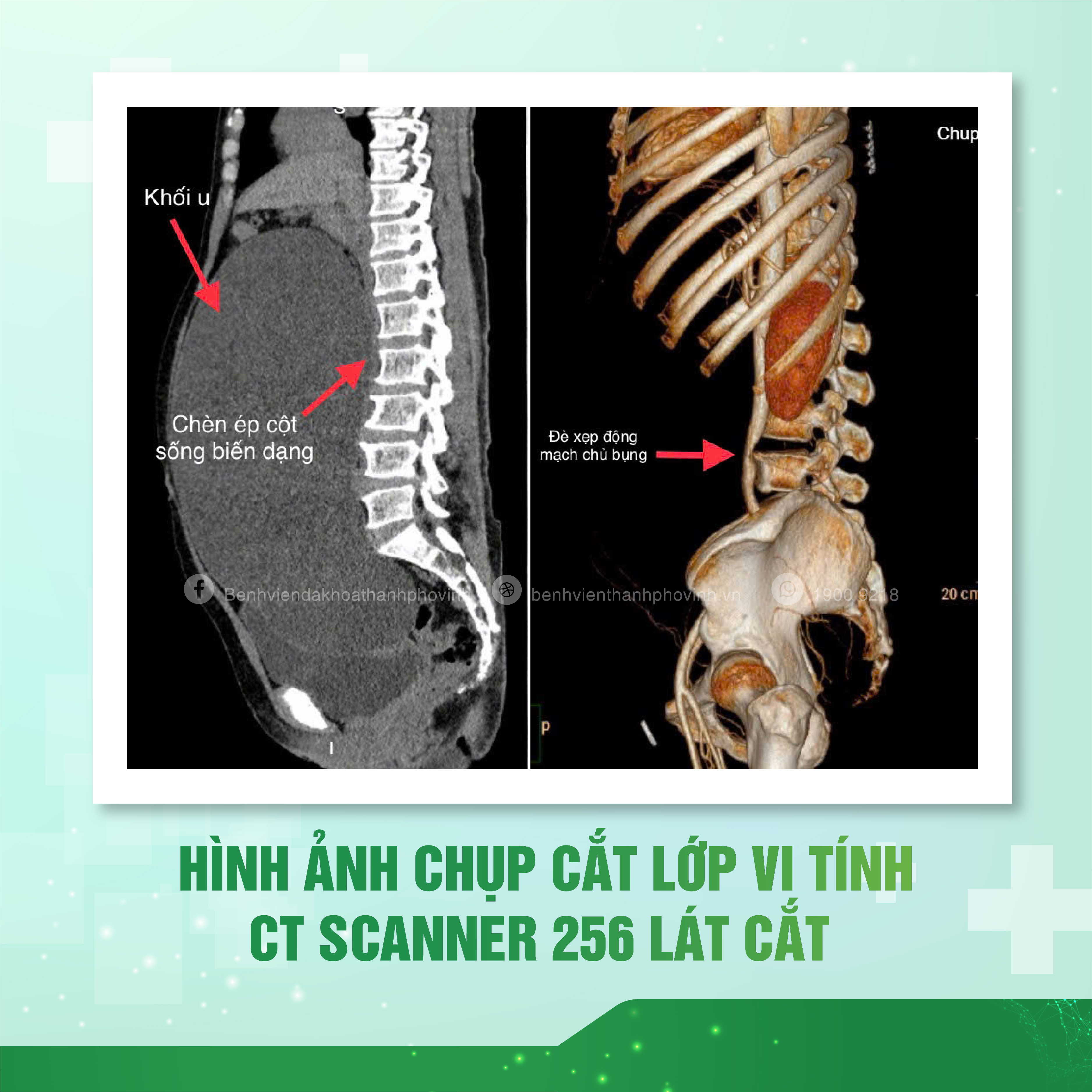 u nang buong trung 0