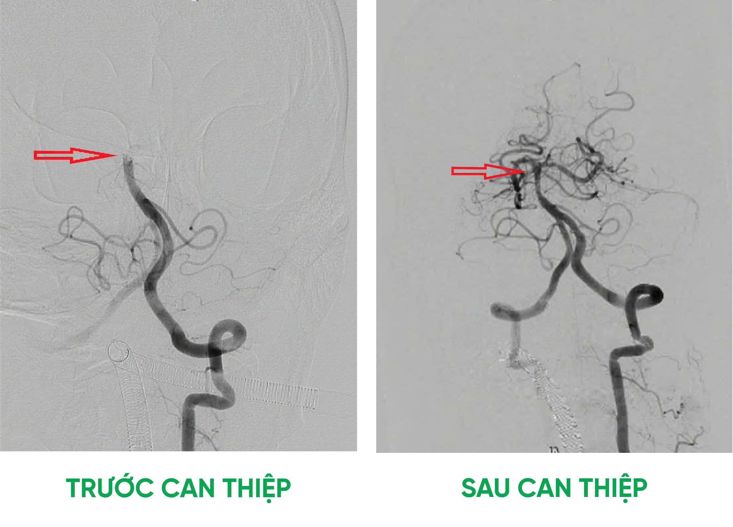 can thiep hoi sinh sau dot quy 1