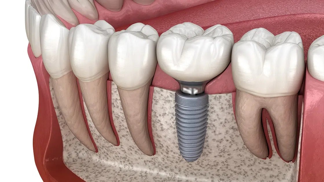 Mách bạn địa chỉ trồng răng chất lượng cao tại Nghệ An