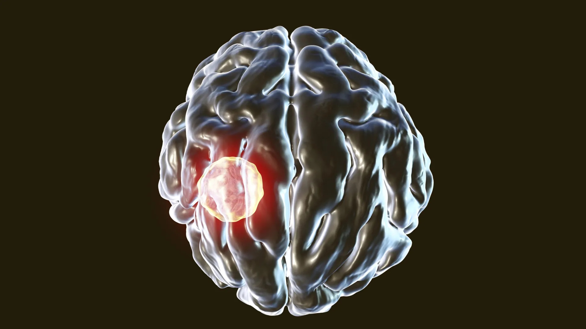 brain abscess caused by parasiti