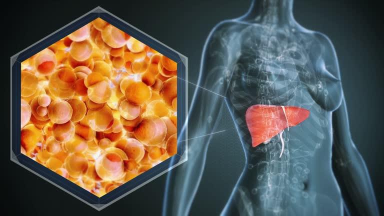 1 bệnh về gan “bùng lên”, người trẻ cũng không còn an toàn: Bác sĩ chỉ ra xu hướng điều trị mới