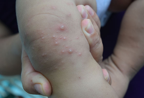 luu y cham tre tcm tai nha 0001