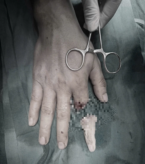 edit bw ngon tay dut roi 1765244906602612894535