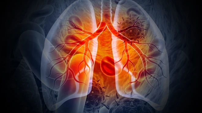lungcancer