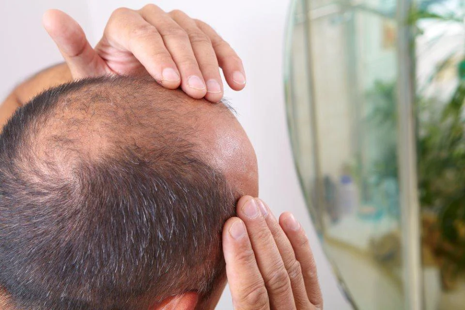 20260518 my 04 baldness fn260518hair001