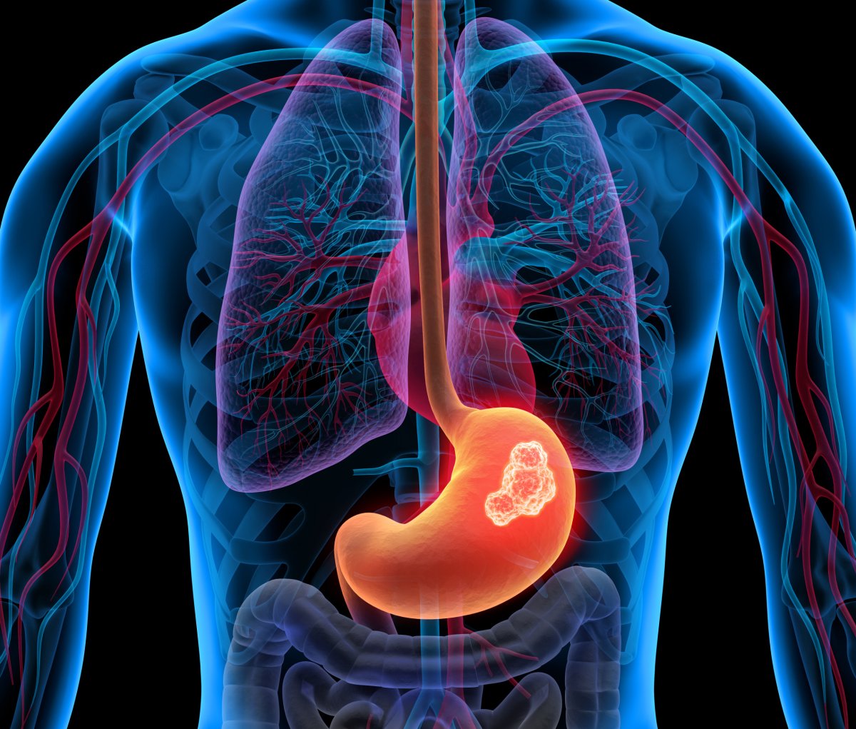 stomach cancer