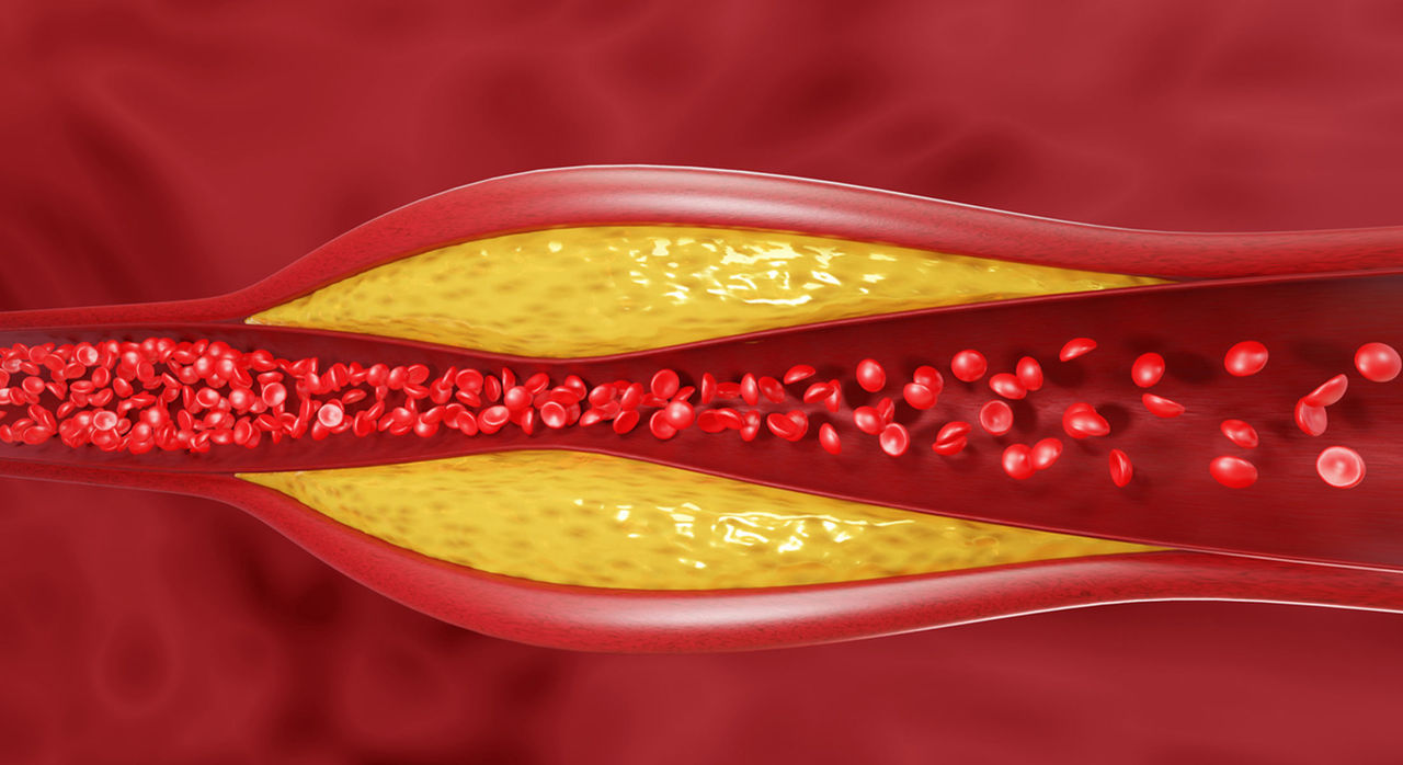 cholesterol plaque buildup 2200x1200