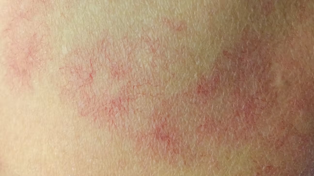 cirrhosis spider angioma body2