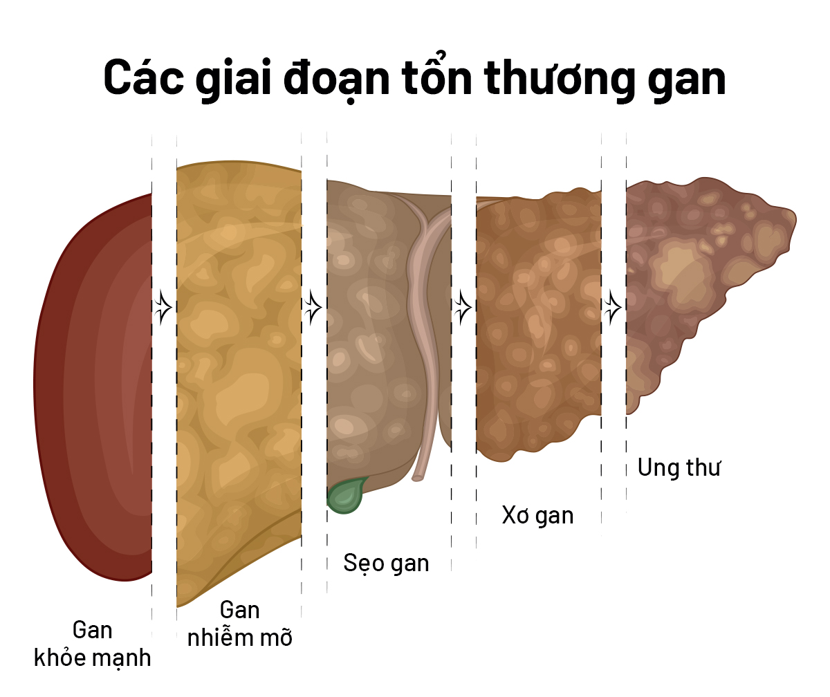 cac kien thuc ban nen biet ve gan nhiem mo 1