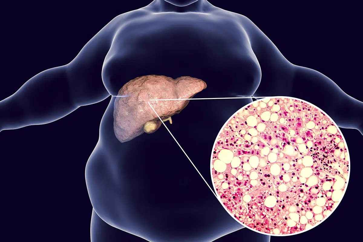 fatty liver in singapore a silent contributor to disease aliveomedical