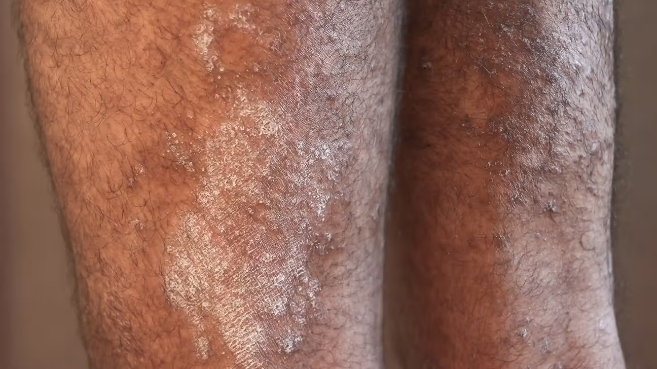 itchyskinrashkidneydisease1296x728slide2