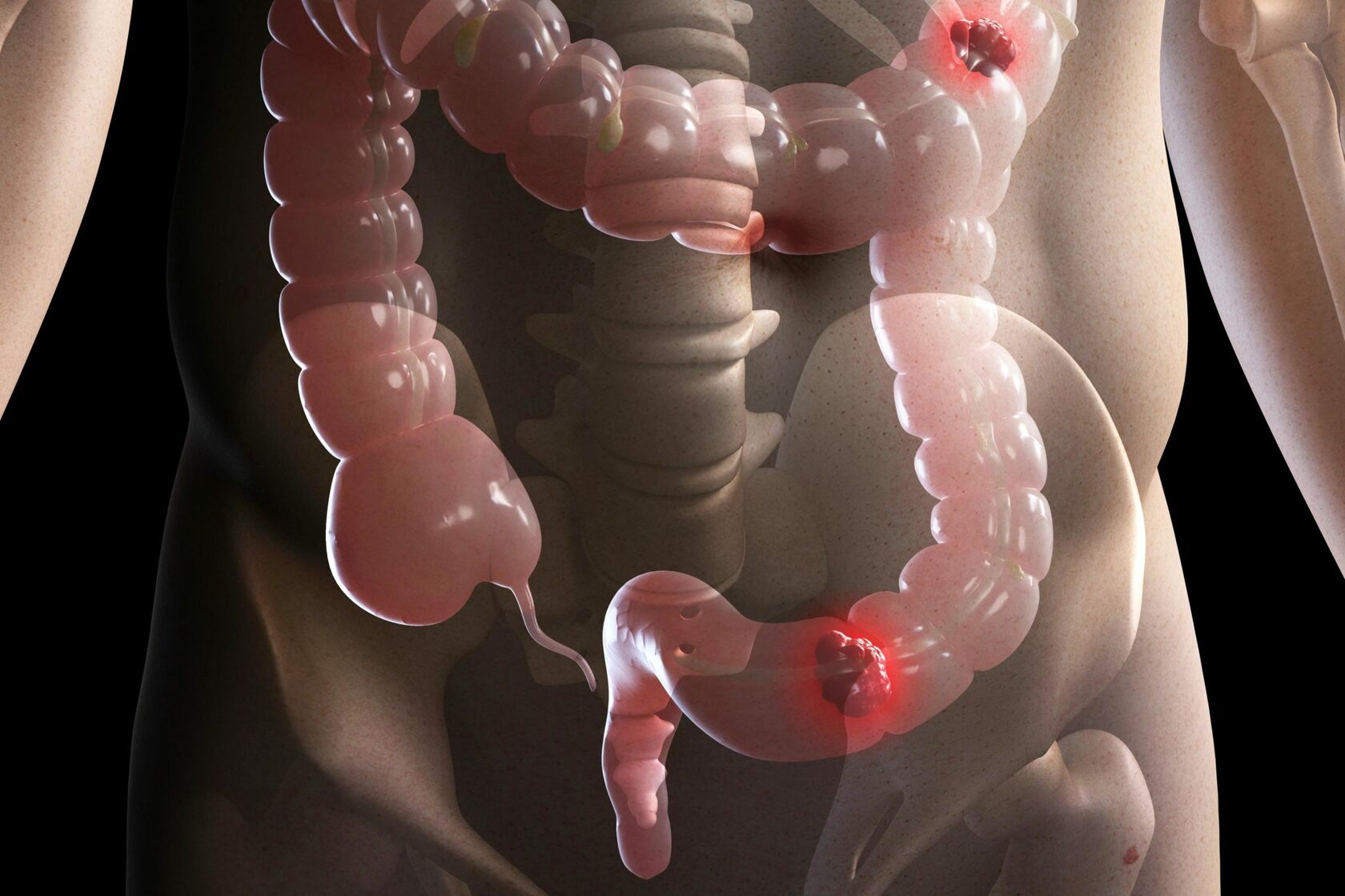 ung thu dai trang di can gan