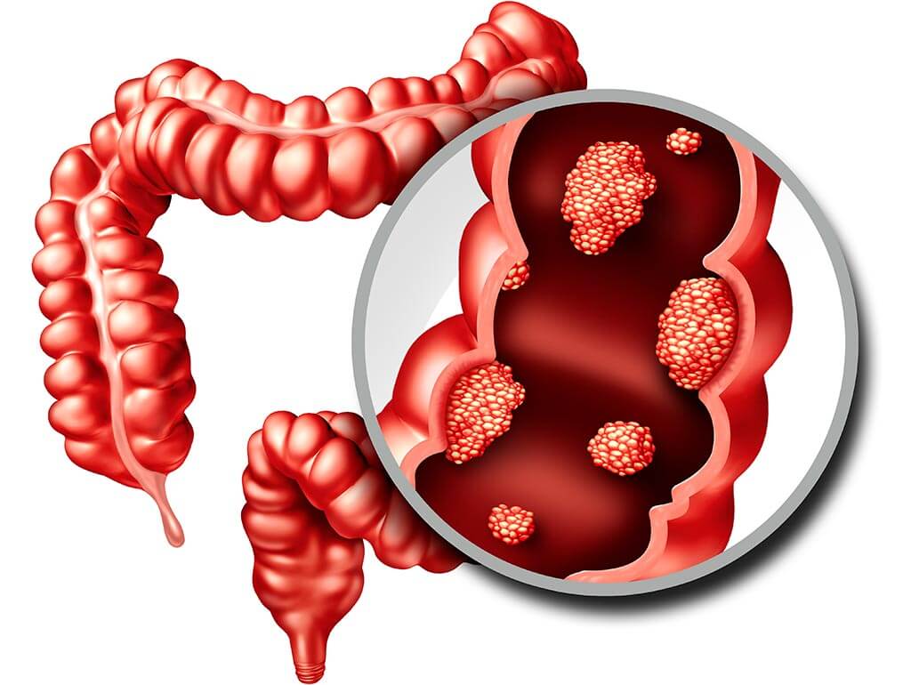 ung thu dai trang 3 1765072875408 17650728758611685919403