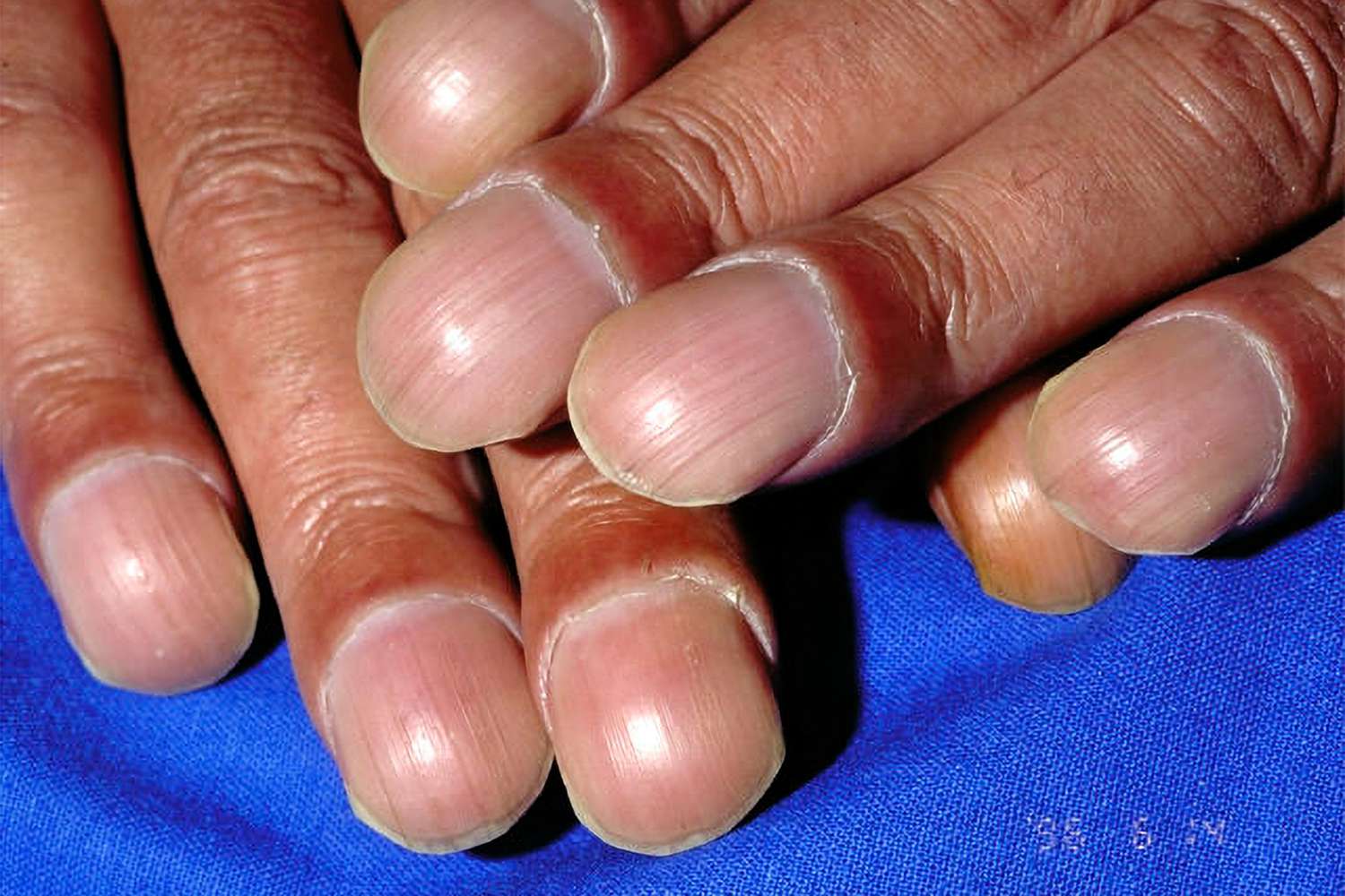 health dermnetnz finger clubbing 360b34c70ac74df5b2bb7389024ddbf0