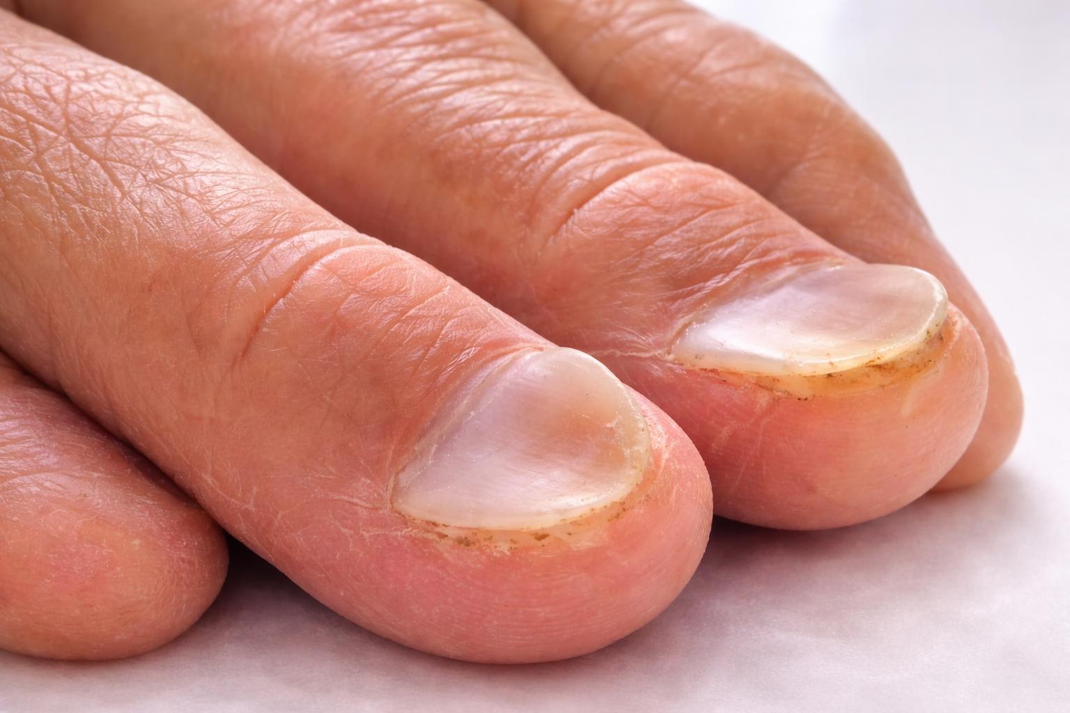 nail spoon shape 1