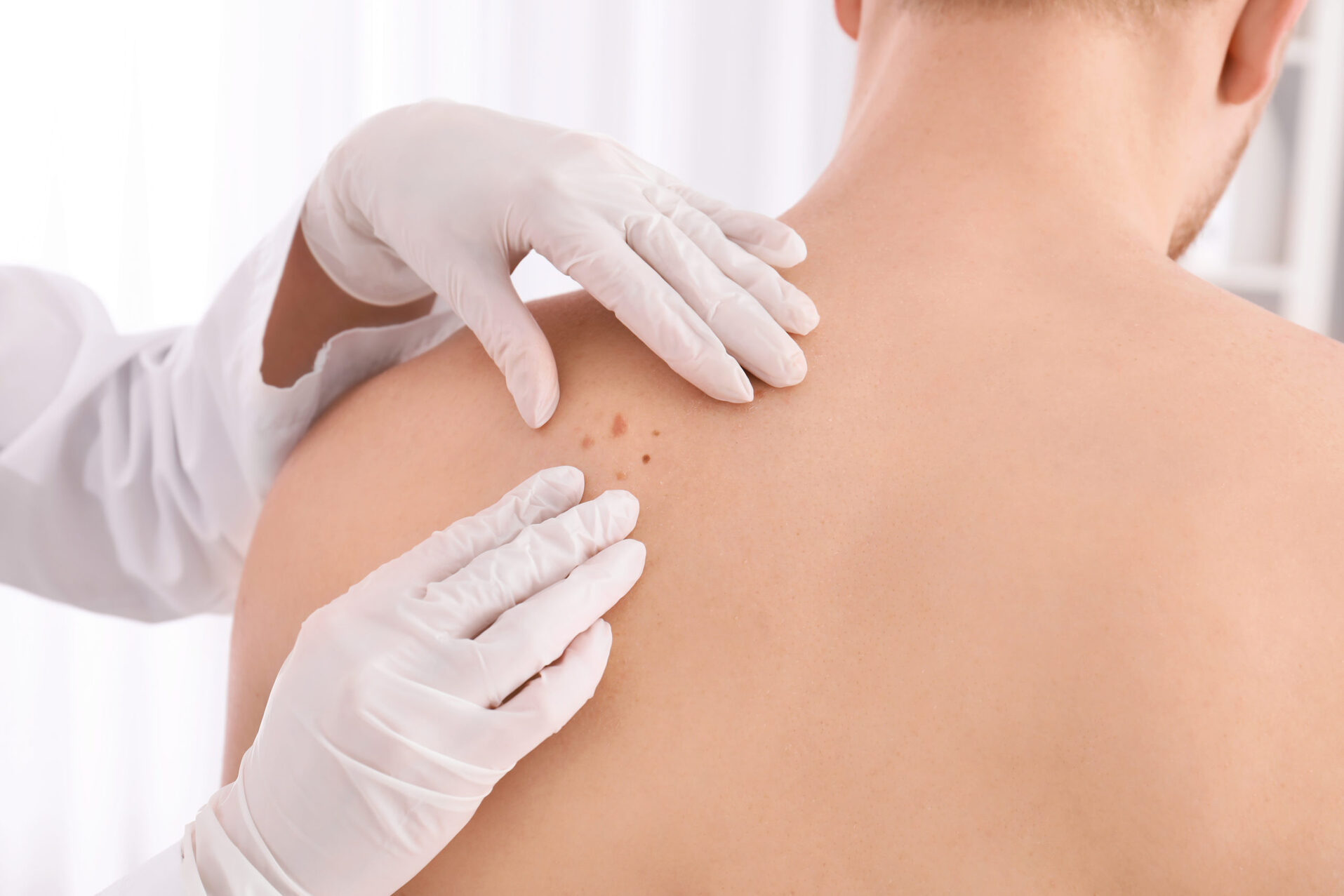 Đây là dấu hiệu sớm nhất của ung thư da nhưng rất hay bị bỏ qua