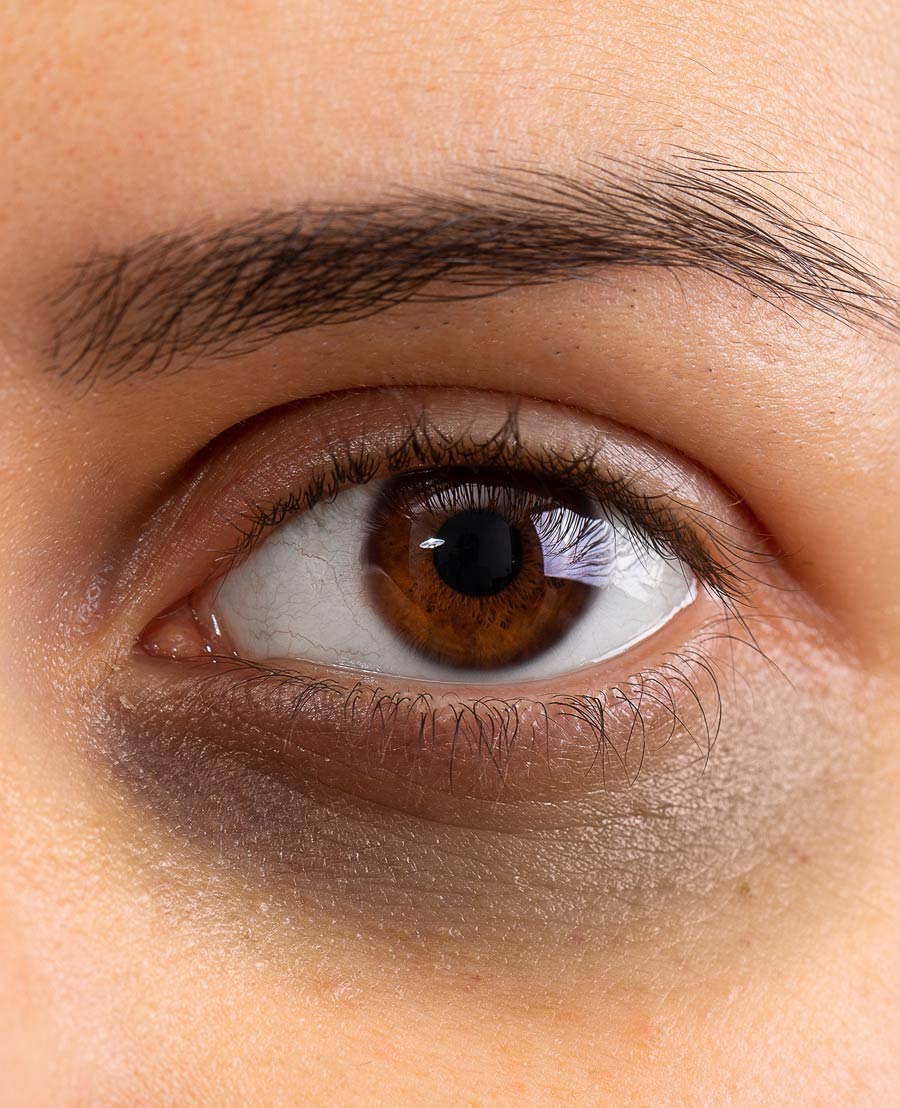 condition teartrough darkcircles