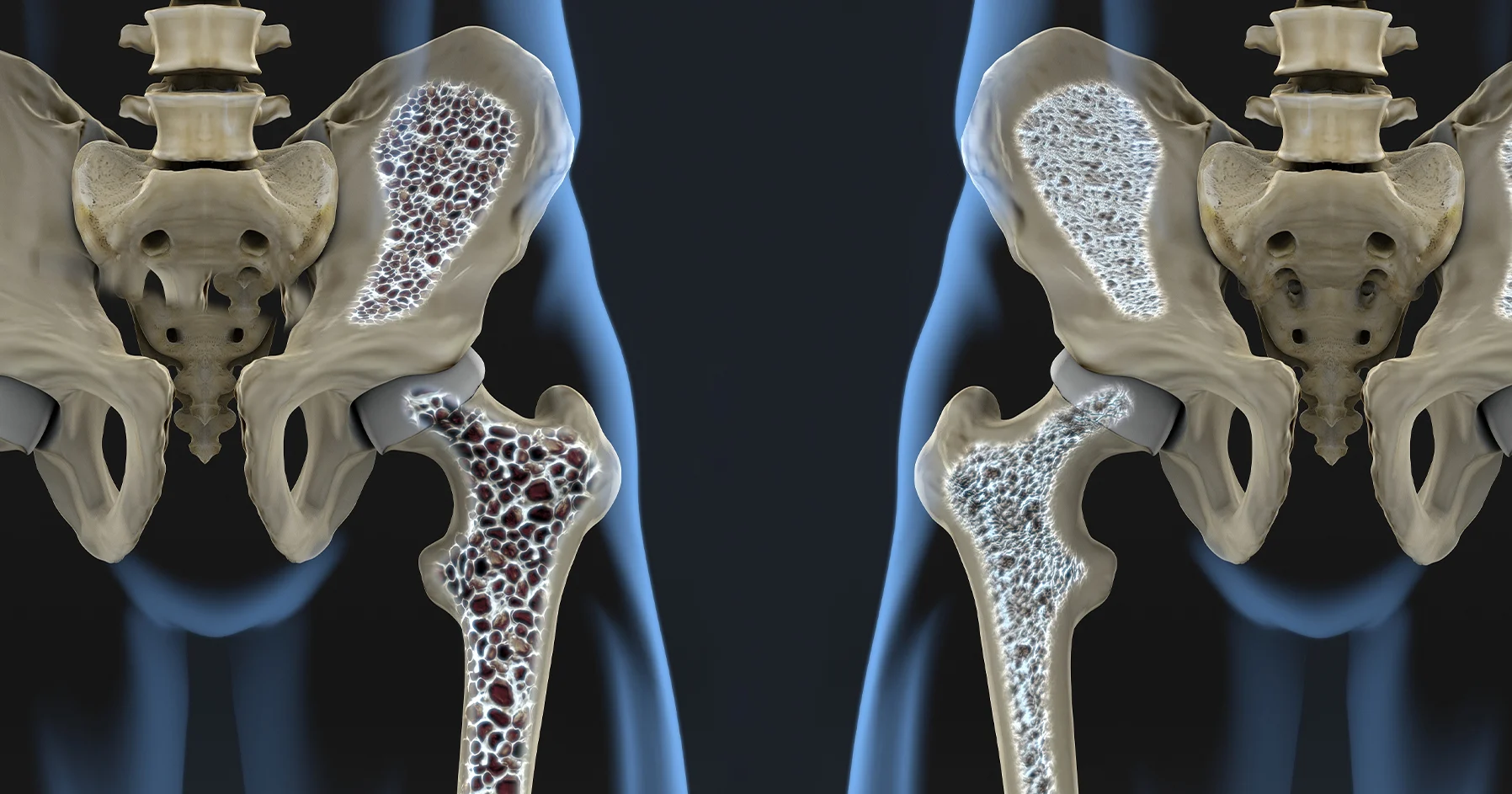 osteoporosispe1796x943