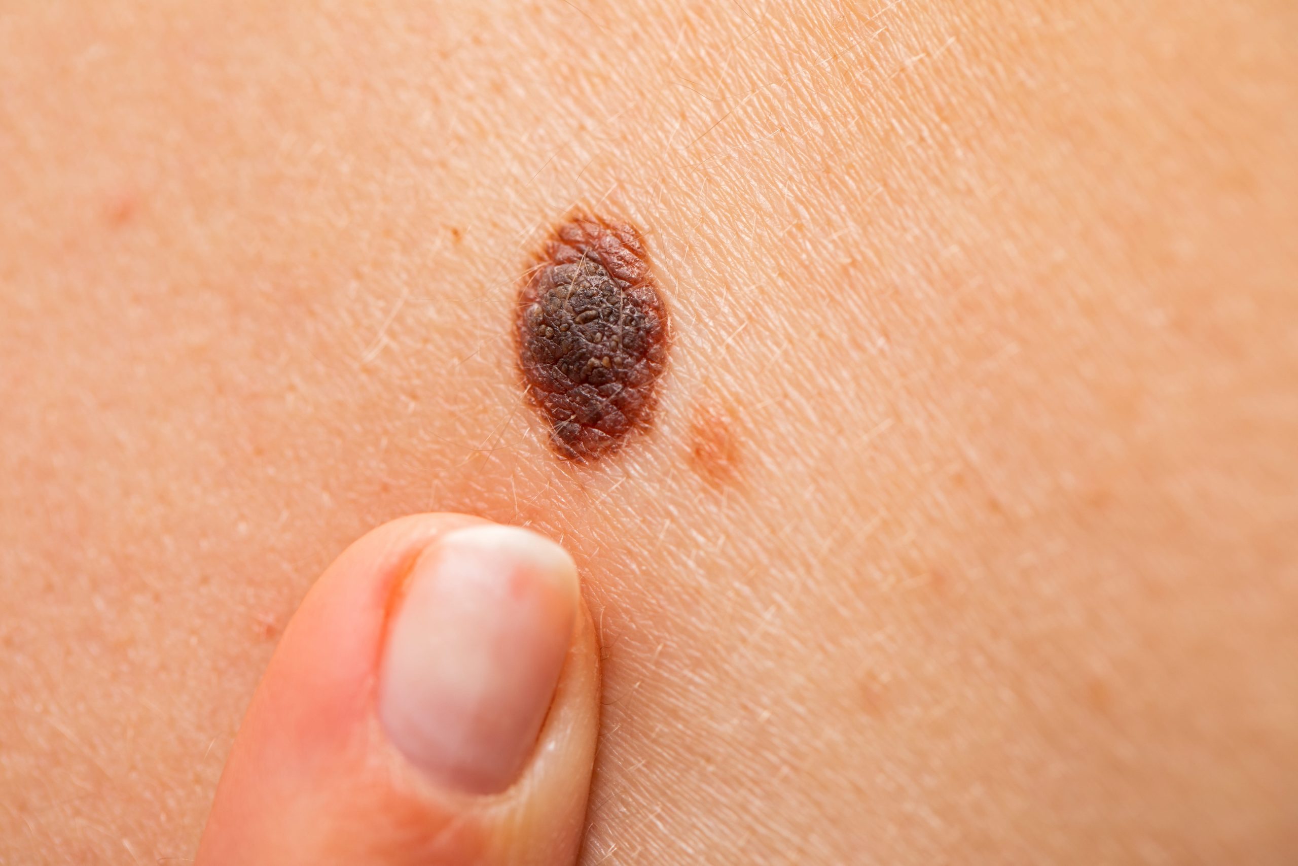 epi blog melanoma scaled