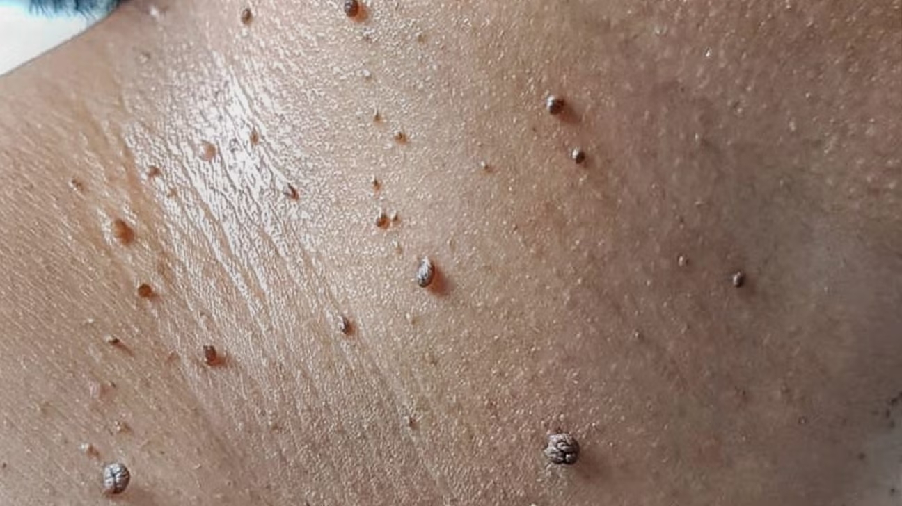 skin tags along the neck 1296x728 galleryslide2