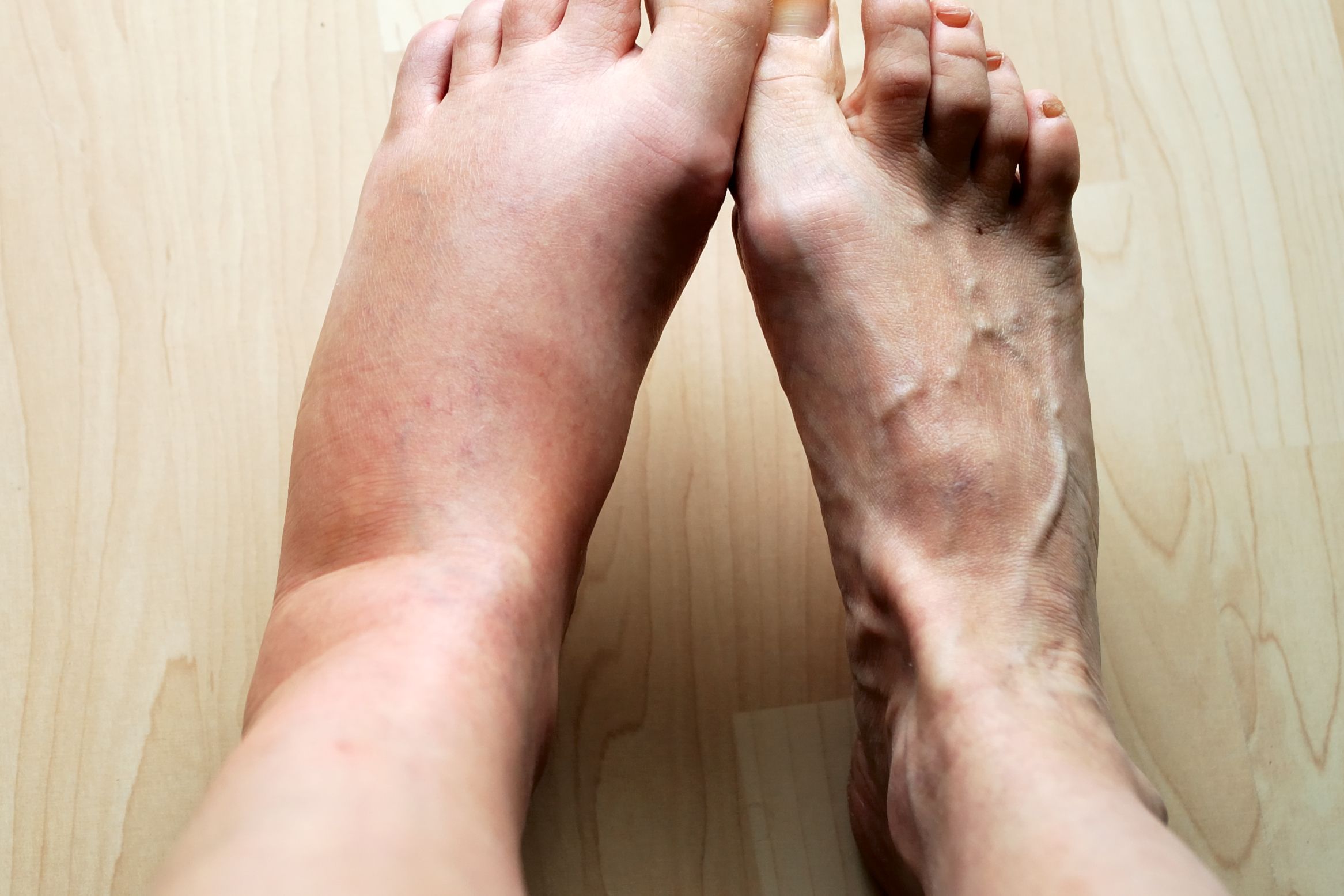 what causes swollen feet