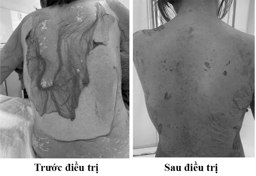 hai phong 1 phu nu 35 tuoi bi troc da nhu cua lot vi thoi quen dung thuoc cuc ky pho bien anh1