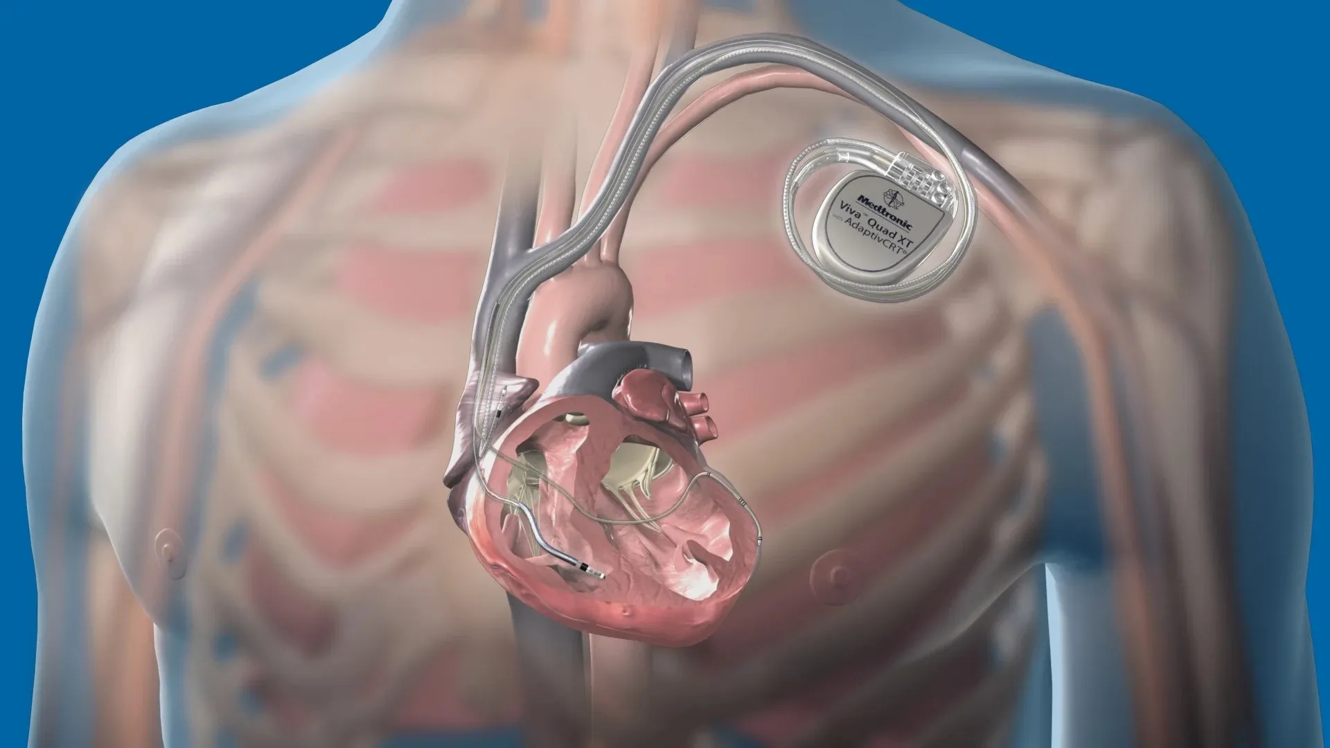 medtronicicddaicjpg