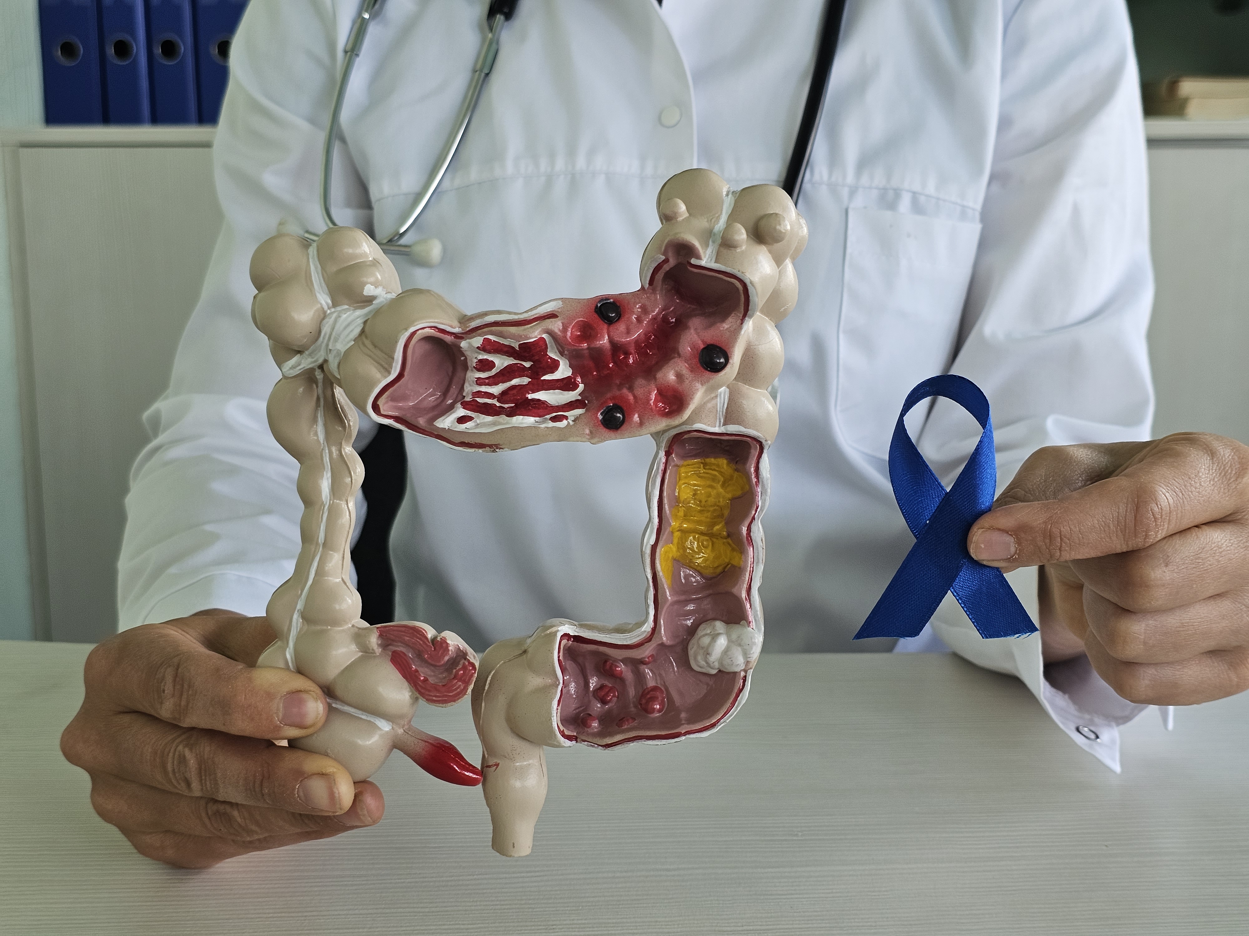 68bb75638af42293b7d3aaaedoctor holds colon model blue ribbon raise awareness about colorectal cancer