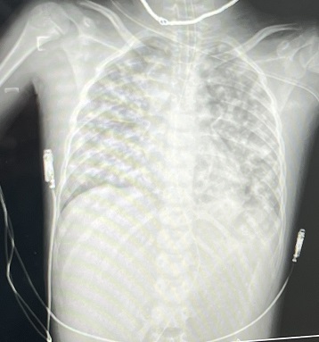 Bé trai có phổi trắng xoá do nhiễm vi khuẩn trong bùn đất sau khi đá bóng - Ảnh 1. Bé trai có phổi trắng xoá do nhiễm vi khuẩn trong bùn đất sau khi đá bóng - Ảnh 1.