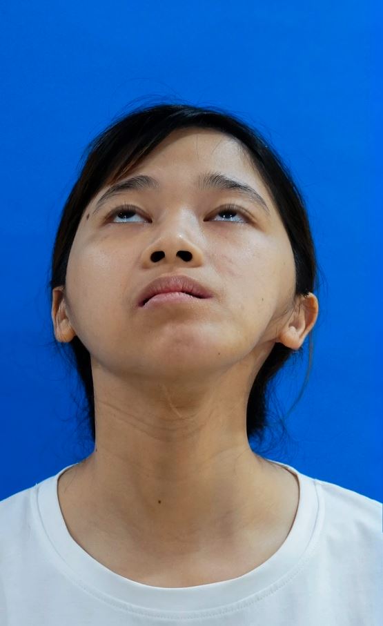 Cô gái mặt lõm 17 năm sống trong khát khao được “lấp đầy”, lột xác sau 4 lần đại phẫu- Ảnh 2.