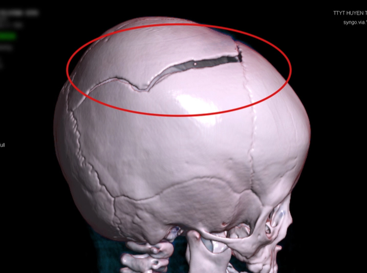 Sập cánh cổng, bé 15 tháng tuổi chấn thương sọ não- Ảnh 1. Sập cánh cổng, bé 15 tháng tuổi chấn thương sọ não- Ảnh 1.