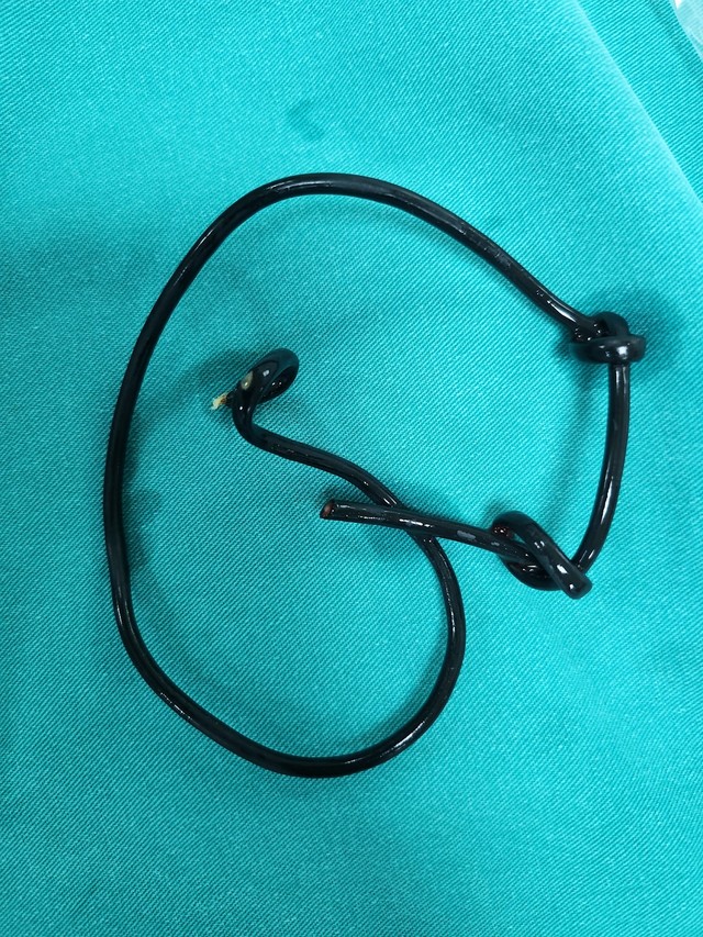 Làm theo trào lưu trên mạng, nam sinh 17 tuổi phải nhập viện cấp cứu lấy dị vật dài 26cm ra khỏi niệu đạo- Ảnh 1. Làm theo trào lưu trên mạng, nam sinh 17 tuổi phải nhập viện cấp cứu lấy dị vật dài 26cm ra khỏi niệu đạo- Ảnh 1.