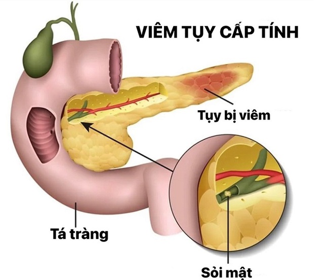 Người đàn ông nhập viện trong tình trạng “thập tử nhất sinh” do lạm dụng thứ đồ uống phổ biến dịp lễ Tết- Ảnh 1.