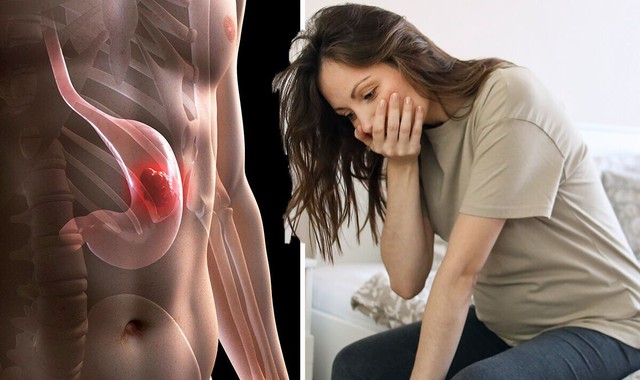 Chủ quan với 1 dấu hiệu suốt 6 tháng, người phụ nữ 36 tuổi đi khám bất ngờ phát hiện mắc ung thư dạ dày- Ảnh 3. Chủ quan với 1 dấu hiệu suốt 6 tháng, người phụ nữ 36 tuổi đi khám bất ngờ phát hiện mắc ung thư dạ dày- Ảnh 3.