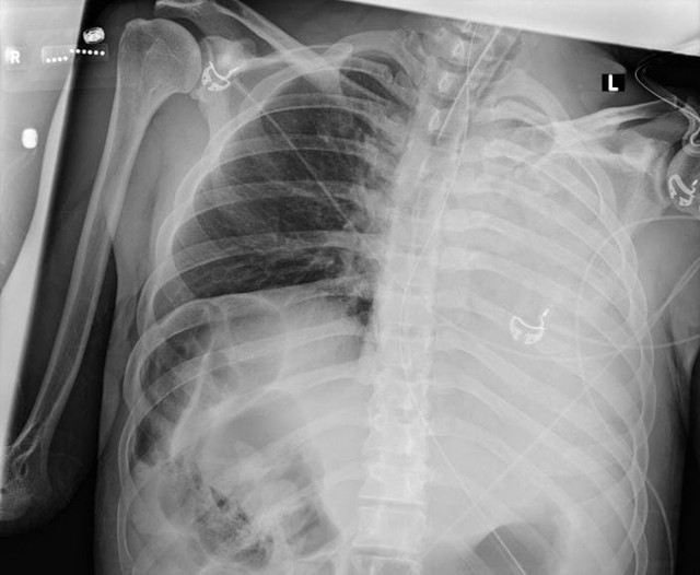 Phổi bị 'đục lỗ', bẹp dúm, thanh niên 25 tuổi hối hận vì đã làm 1 điều suốt nhiều năm- Ảnh 1. Phổi bị 'đục lỗ', bẹp dúm, thanh niên 25 tuổi hối hận vì đã làm 1 điều suốt nhiều năm- Ảnh 1.
