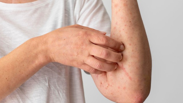 Người có thận khỏe sẽ không có 3 dấu hiệu này trên da: Nếu không có tất cả thì xin chúc mừng!- Ảnh 2. Người có thận khỏe sẽ không có 3 dấu hiệu này trên da: Nếu không có tất cả thì xin chúc mừng!- Ảnh 2.