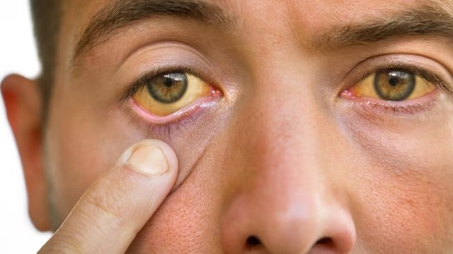 9 dấu hiệu cho thấy gan đang ‘kêu cứu’: Có 1 cũng cần đi khám sớm- Ảnh 1.