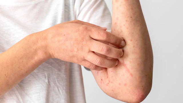 9 dấu hiệu cho thấy gan đang ‘kêu cứu’: Có 1 cũng cần đi khám sớm- Ảnh 2. 9 dấu hiệu cho thấy gan đang ‘kêu cứu’: Có 1 cũng cần đi khám sớm- Ảnh 2.