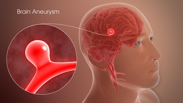 Người đàn ông suýt chết sau một cơn đau đầu: BS cảnh báo người có 1 trong 7 đặc điểm này cần cẩn trọng- Ảnh 2. Người đàn ông suýt chết sau một cơn đau đầu: BS cảnh báo người có 1 trong 7 đặc điểm này cần cẩn trọng- Ảnh 2.