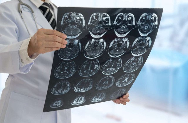 Người đàn ông đột quỵ 3 lần trong 2 năm, hôn mê sâu: BS nói nguyên nhân đến từ 1 sai lầm “chí mạng”- Ảnh 1. Người đàn ông đột quỵ 3 lần trong 2 năm, hôn mê sâu: BS nói nguyên nhân đến từ 1 sai lầm “chí mạng”- Ảnh 1.