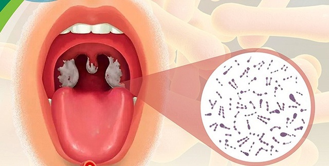 Bệnh bạch hầu có tỷ lệ tử vong cao hơn COVID-19: Liệu có thể lây lan thành đại dịch?- Ảnh 1. Bệnh bạch hầu có tỷ lệ tử vong cao hơn COVID-19: Liệu có thể lây lan thành đại dịch?- Ảnh 1.