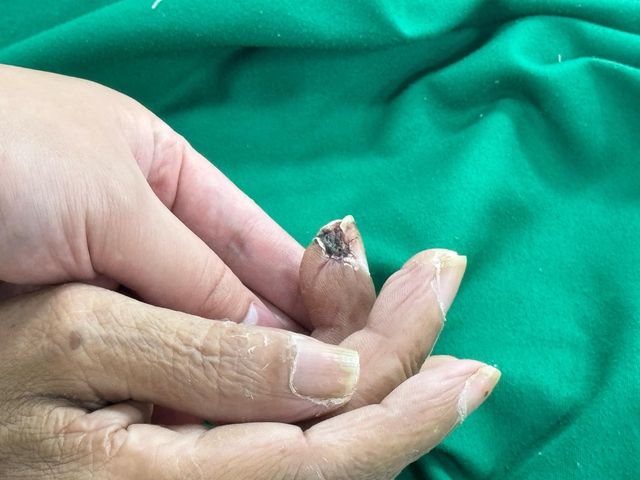 Bắc Ninh: Người đàn ông lên cơn co giật, nguy kịch chỉ sau 8 ngày bị mảnh gỗ đâm vào tay, bác sĩ cảnh báo- Ảnh 1. Bắc Ninh: Người đàn ông lên cơn co giật, nguy kịch chỉ sau 8 ngày bị mảnh gỗ đâm vào tay, bác sĩ cảnh báo- Ảnh 1.