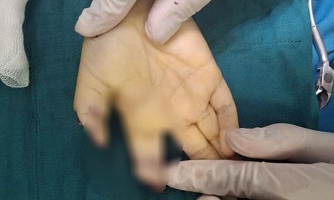 Vụ bé trai đứt lìa 2 ngón tay vì chơi xe điện tự chế: Bác sĩ chia sẻ điều đáng lo ngại