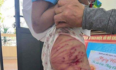 Vụ bé gái lớp 5 bị bạo hành ở Hà Tĩnh: Công an triệu tập cha dượng 