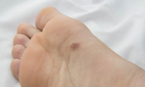 Có dấu hiệu lạ ở lòng bàn chân, người đàn ông làm ngay 1 việc: Được bác sĩ khen vì phát hiện ung thư sớm