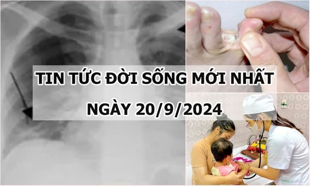 Tin tức đời sống 20/9/2024: Cần lưu ý điều gì khi bị nấm chân mùa lũ?