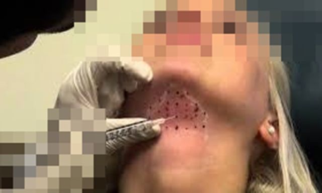Bi hài hậu vận sau thẩm mỹ: Cô gái trẻ 23 tuổi 