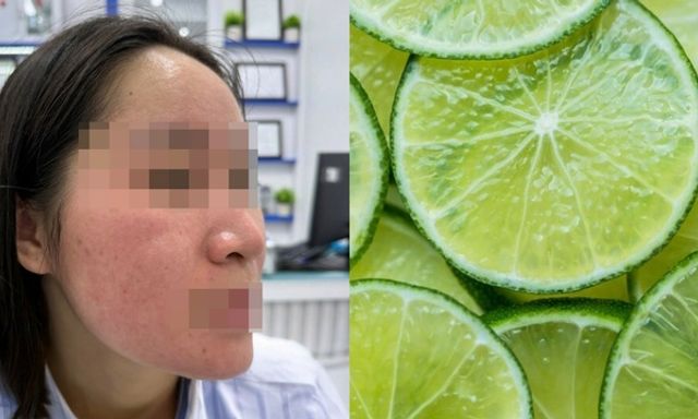 Dùng nước chanh trị mụn theo trên mạng, cô gái trẻ 