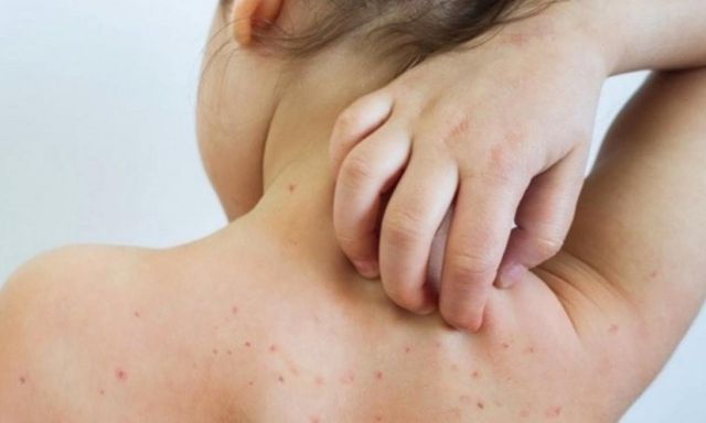 Một ca rubella vừa phát hiện: Bố mẹ chủ quan, trẻ lãnh hậu quả