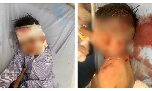 Cháu bé 3 tuổi ở Lào Cai bị chó hàng xóm cắn trọng thương